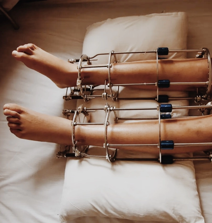 Leg Lengthening Surgery